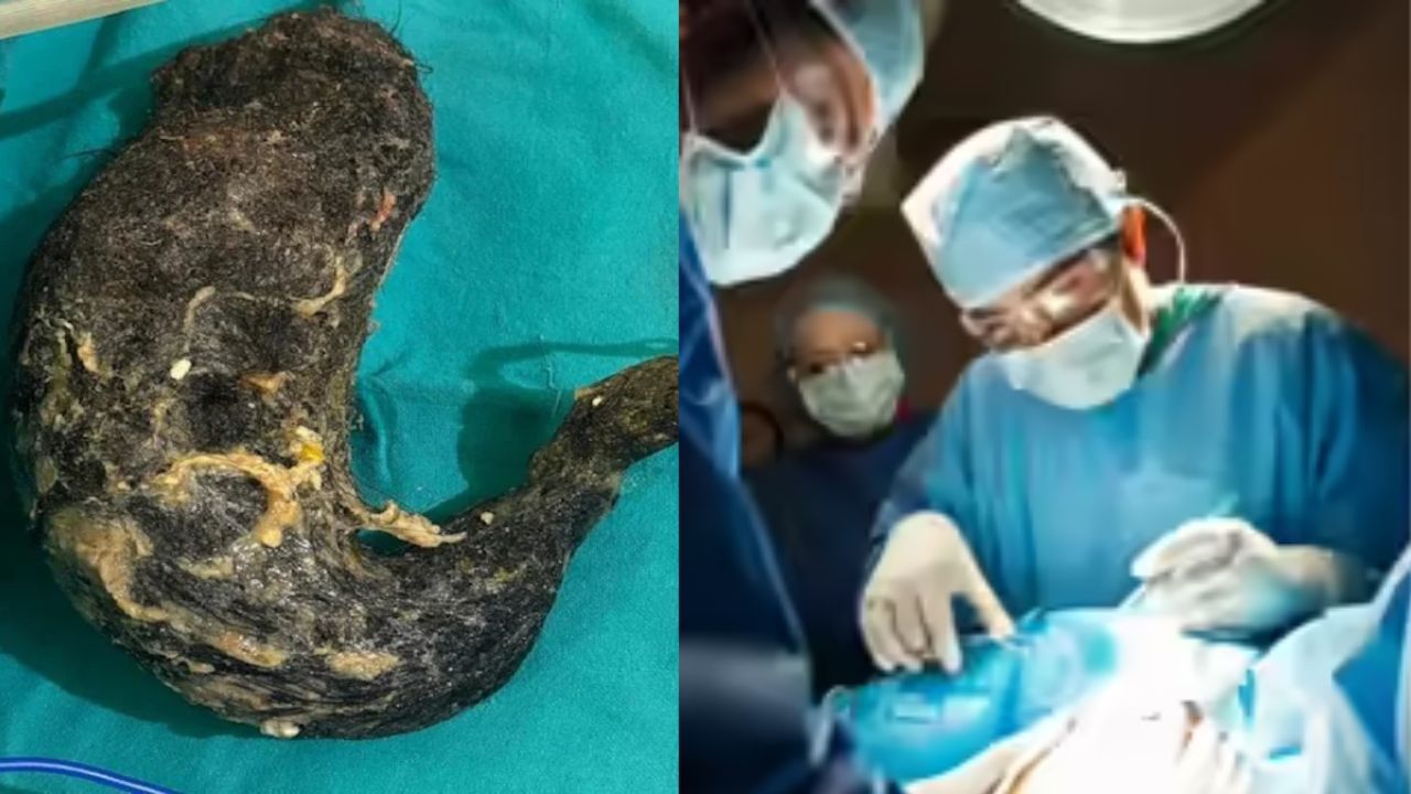 युवती को था पेट में दर्द, सोनोग्राफी रिपोर्ट देख चौंक गए डॉक्टर; पता चला कि… युवती को था पेट में दर्द, सोनोग्राफी रिपोर्ट देख चौंक गए डॉक्टर; पता चला कि…