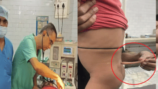 मासूम की पीठ पर उगी थी 14 cm लंबी पूंछ, बजरंगबली मानकर पूज रहे थे मां-बाप, डॉक्टरों ने ऐसे बचाई जान