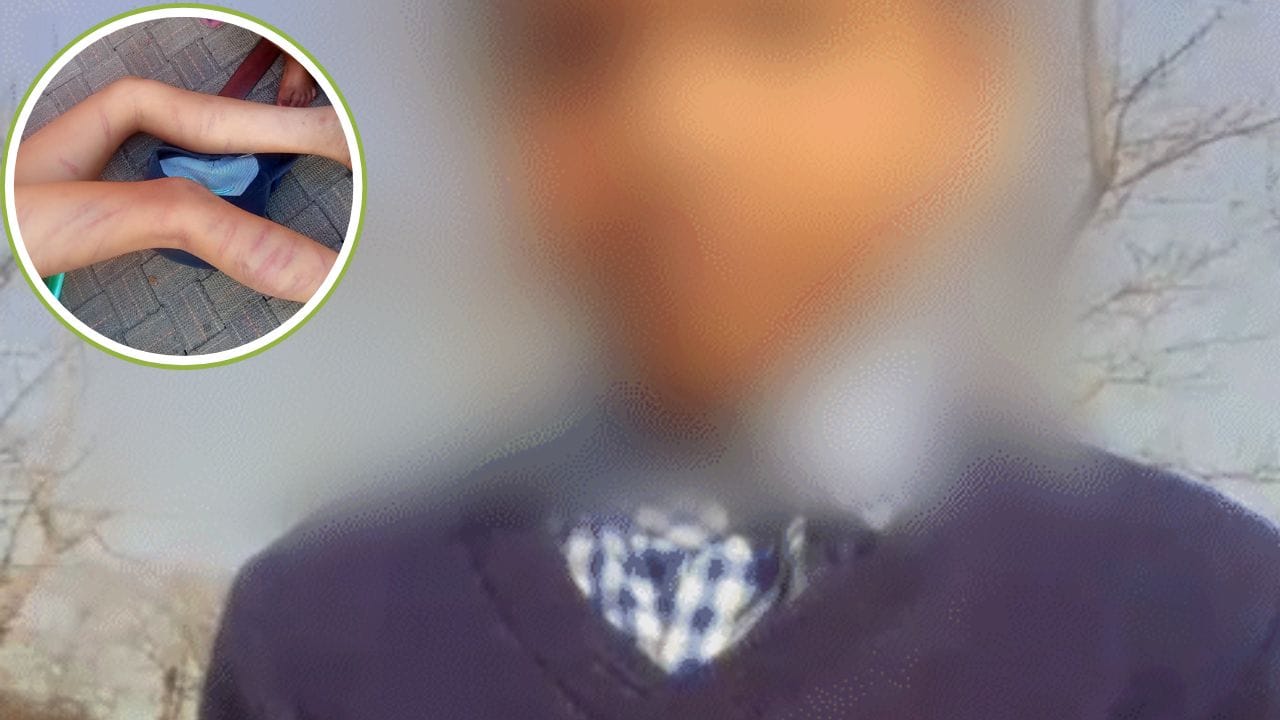 पूरा नहीं था होमवर्क, देखते ही हैवान बना टीचर; मासूम को मारे 105 डंडे