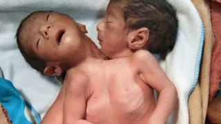 अलीगढ़ में धड़ से जुड़े दुर्लभ जुड़वां बच्चों का जन्म, प्रसव के दौरान मां की मौत