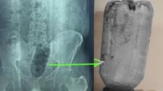 युवक पर चढ़ी ऐसी सनक, अपने ही निजी अंग में डाल दी पानी की बोतल