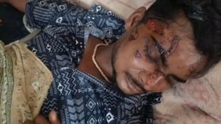 हाय रे व्यवस्था! मोबाइल फोन फटने से जख्मी था युवक, टांके की जगह डॉक्टरों ने लगाया स्टेपलर पिन